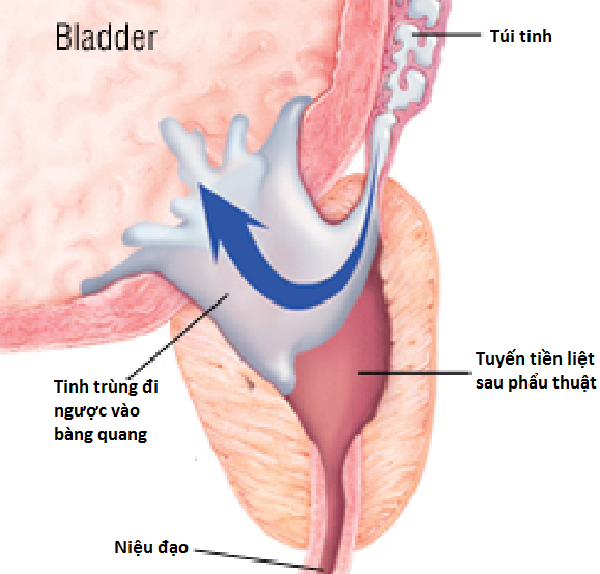 Rối loạn chức năng của “cánh cửa” bàng quang – niệu đạo là cơ chế gây ra hiện tượng đi tiểu ra tinh trùng