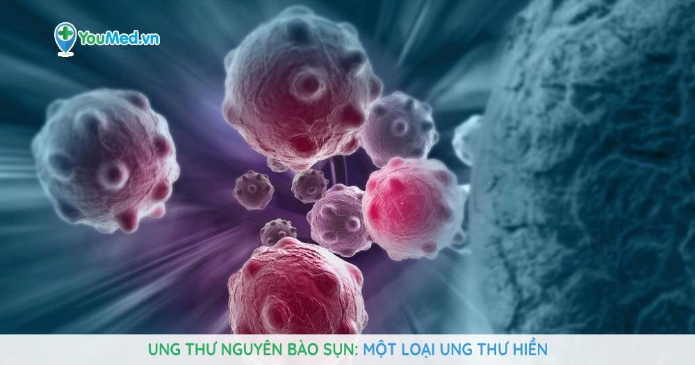 Ung thư nguyên bào sụn: Một loại ung thư hiền!