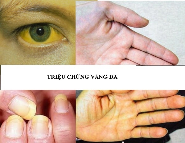 triệu chứng vàng da