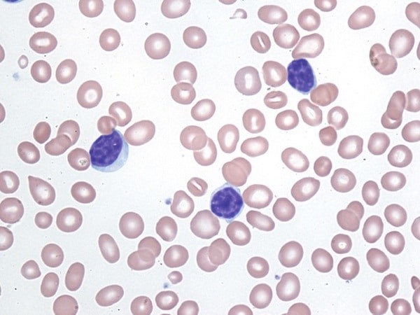 Các tế bào lympho bất thường trên lam máu