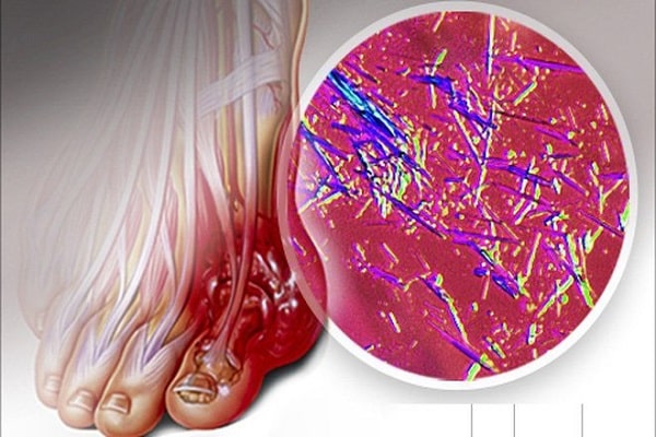 Acid uric trong máu cao có thể gây bệnh Gout