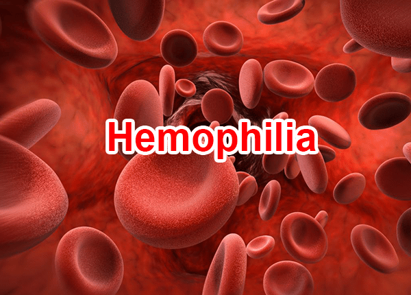 Bệnh Hemophilia khá phổ biến