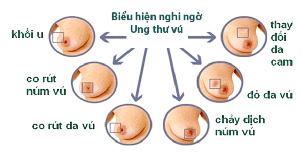 Bất kỳ thay đổi nhỏ nào ở hình dáng và cấu trúc da vú cũng cần được quan tâm 