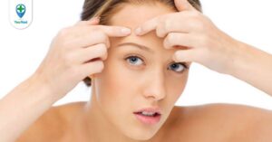 Nặn mụn xong nên làm gì? Chăm sóc da sau nặn mụn đúng cách