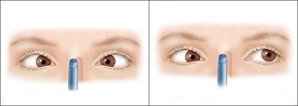 Mắt người bị Suy giảm khả năng hội tụ