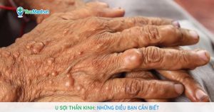 U sợi thần kinh: Những điều bạn cần biết