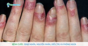 Bệnh cước (Chilblains): nguyên nhân, điều trị và phòng ngừa