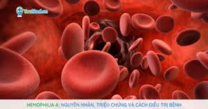 Hemophilia A: Nguyên nhân, triệu chứng và cách điều trị bệnh