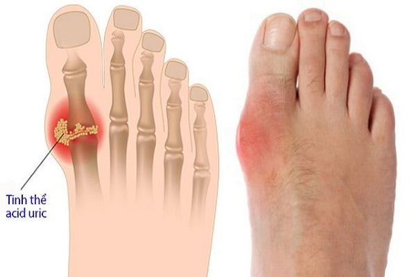 Hình ảnh người mắc bệnh Gout