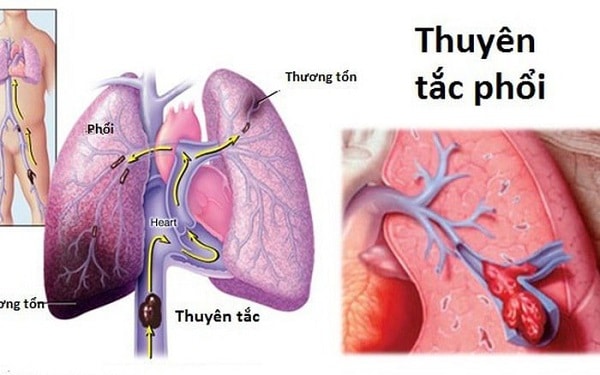 Thuyên tắc phổi