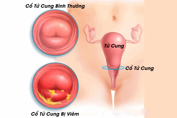 Viêm cổ tử cung là biến chứng rất thường gặp