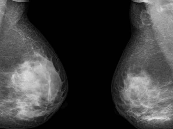 chụp X-quang tuyến vú có thể cho thấy nguyên nhân dẫn đến một bên vú bị to