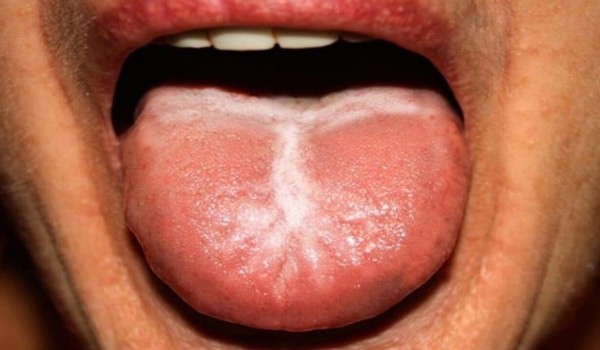 Những mảng trắng có thể báo hiệu bệnh về lưỡi như lichen phẳng