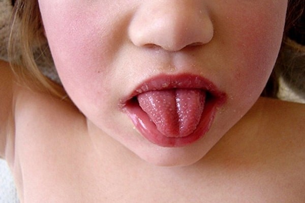 Bệnh về lưỡi này báo hiệu cơ thể đang thiếu một số chất