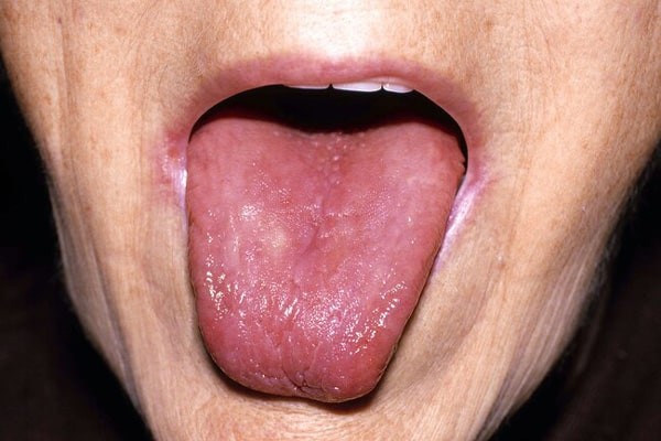 Lưỡi trơn láng có thể là một bệnh về lưỡi