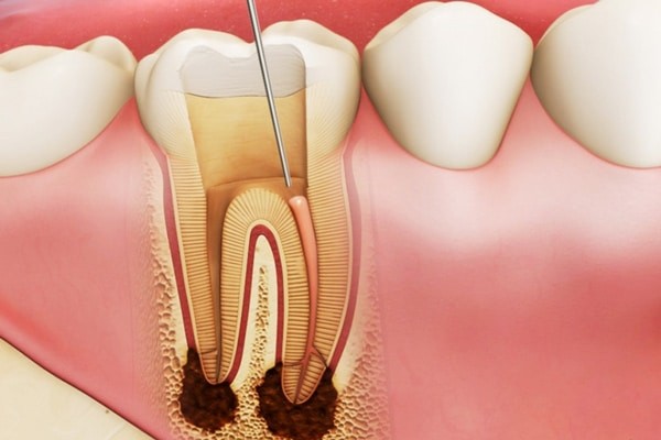 Tủy răng giúp duy trì sự sống của răng