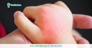 Các loại ban da ở trẻ sơ sinh