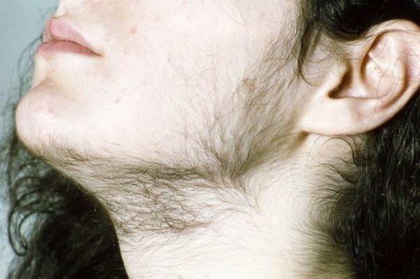 Triệu chứng rậm lông vùng hàm của bệnh cường Adrogen
