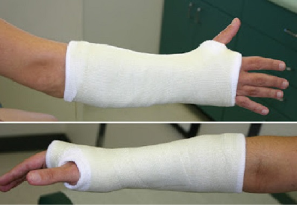 Gãy xương cẳng tay  4 lưu ý khi chăm sóc người bệnh sau bó bột