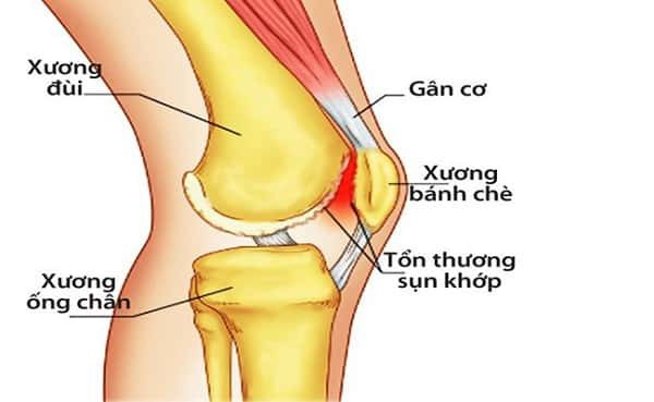 Xương Bánh Chè Nằm Ở Đâu? Vị Trí, Vai Trò Và Những Vấn Đề Cần Lưu Ý