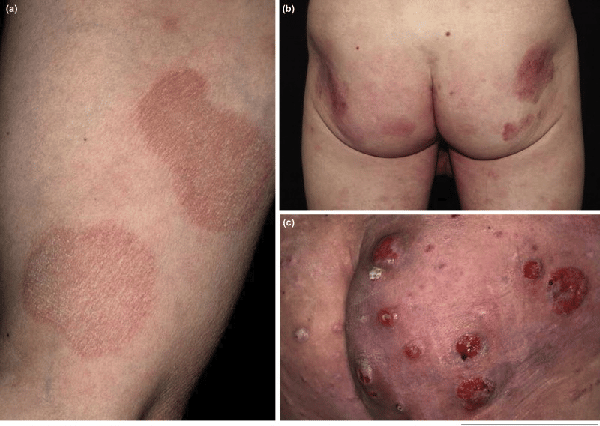 Hình ảnh minh họa các triệu chứng u lympho T tế bào da