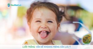 Lưỡi trắng: Vấn đề khoang miệng cần lưu ý