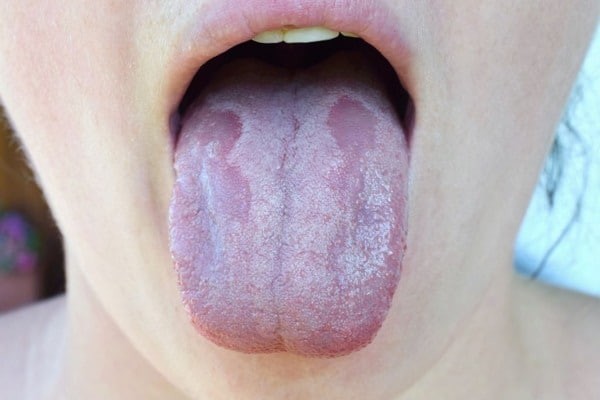 nấm miệng là nguyên nhân gây bệnh lưỡi trắng