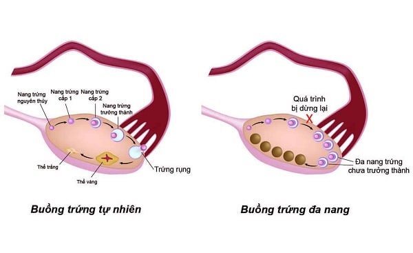 Sự rụng trứng ở buồng trứng bình thường và buồng trứng đa nang