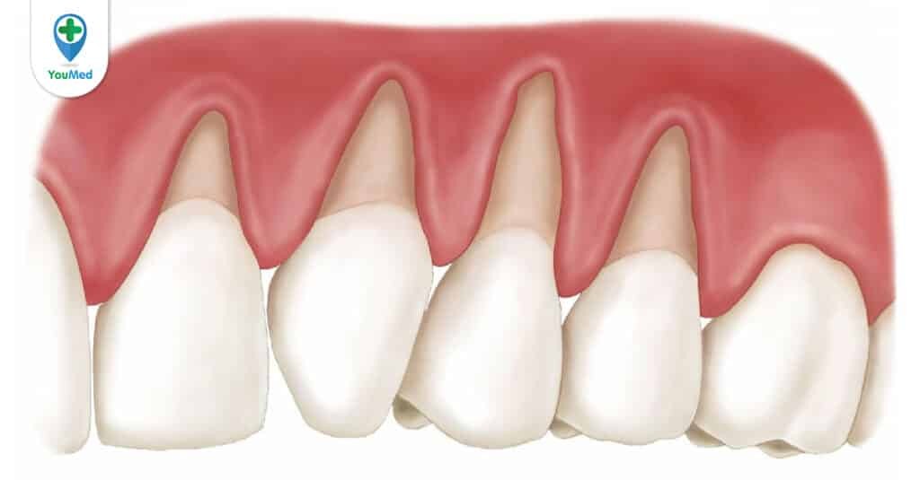 Nướu răng: Mô mềm quan trọng bao quanh răng