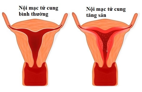 tăng sản nội mạc tử cung