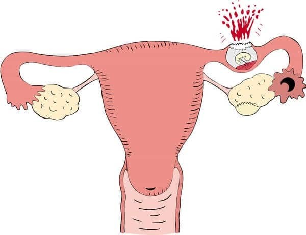 Khối thai ngoài tử cung đã vỡ và/hoặc gây các biến chứng như chảy máu trong ổ bụng