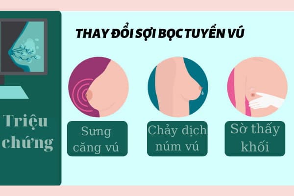 4. Chẩn đoán và điều trị thay đổi sợi bọc tuyến vú