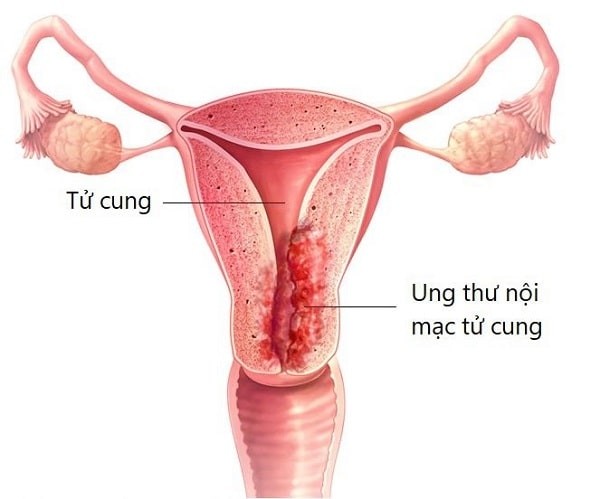 ung thư nội mạc tử cung