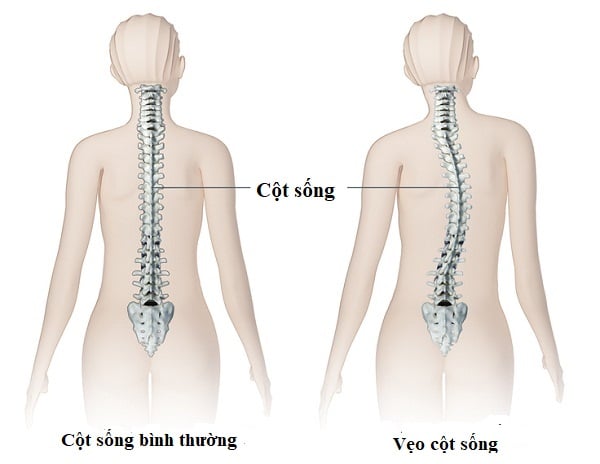 Hình ảnh cột sống bình thường và cột sống bị vẹo