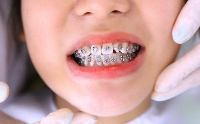 Niềng răng cho trẻ khi có dấu hiệu răng mọc lệch