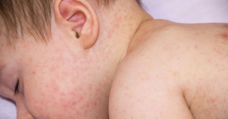 Triệu chứng rõ ràng nhất của bệnh sốt phát ban Rocky Mountain là phát ban trên da