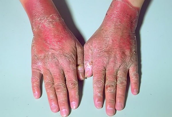 Biểu hiện trên da của bệnh Pellagra ở bàn tay