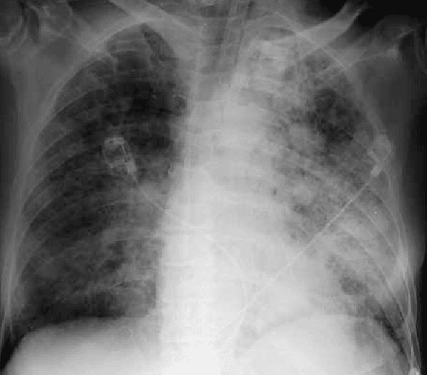 Chụp X-quang ngực giúp đánh giá mức độ tổn thương phổi