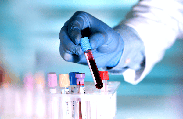 Xét nghiệm CRP và tốc độ lắng máu để đánh giá tình trạng viêm