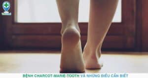 Bệnh Charcot-Marie-Tooth (teo cơ Mác): nguyên nhân, triệu chứng và điều trị