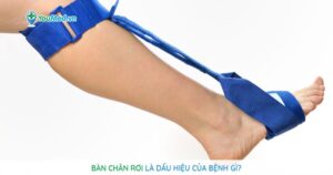 Bàn chân rơi là dấu hiệu của bệnh gì?