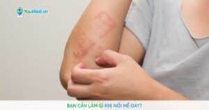 Nổi mề đay: nguyên nhân, triệu chứng và cách điều trị