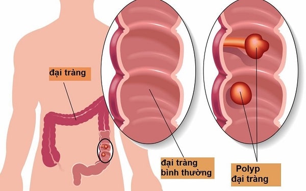 Bệnh đa polyp gia đình