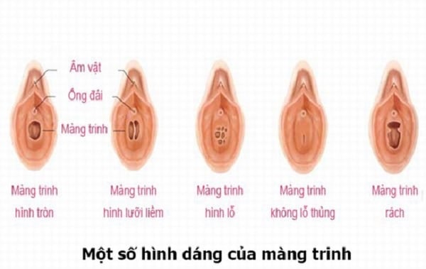 Màng trinh nằm ở vị trí nào Cách xác định vị trí màng trinh  MarryBaby