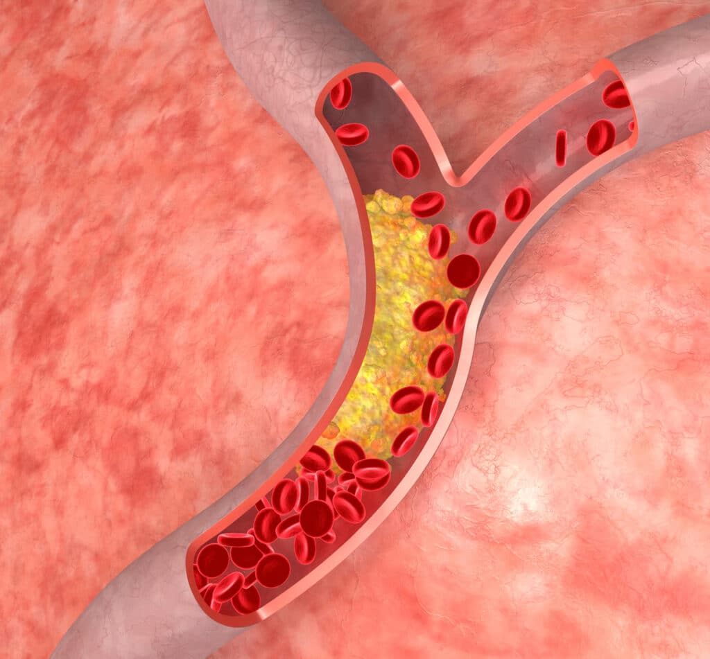 Cholesterol trong máu