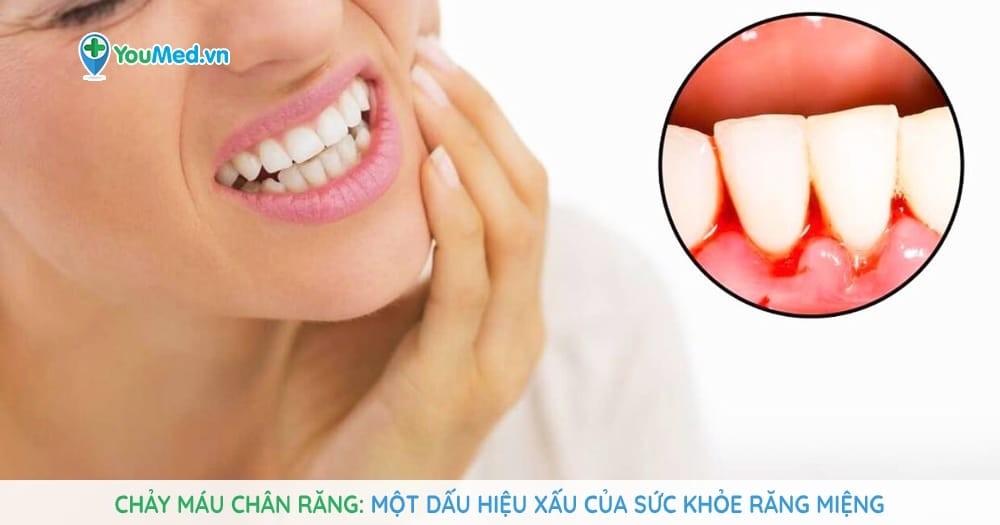 Chảy máu chân răng - Một dấu hiệu xấu của sức khỏe răng miệng