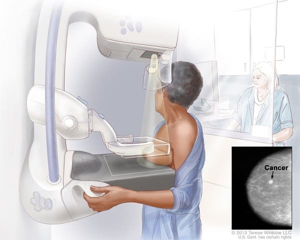 Chụp X quang tuyến vú để phát hiện bất thường khi nghi ngờ ung thư vú
