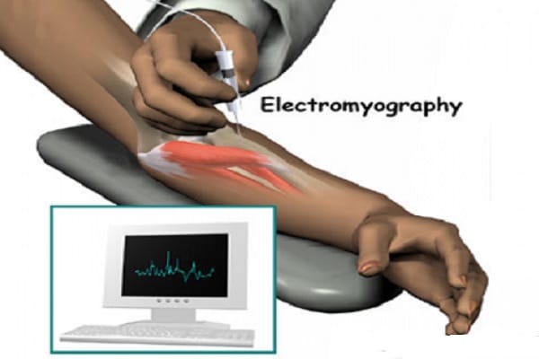 Xét nghiệm điện cơ EMG