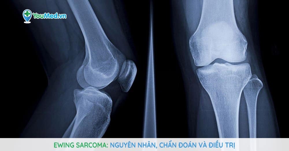 Ewing sarcoma: Nguyên nhân, chẩn đoán và điều trị