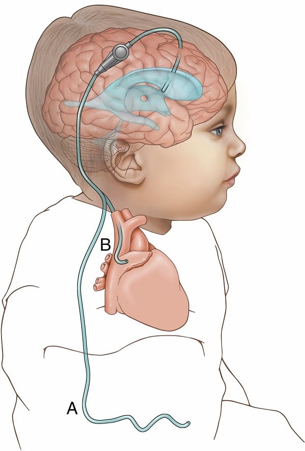 Nếu có não úng thủy, ống dẫn lưu có thể được đặt để thoát dịch não tủy